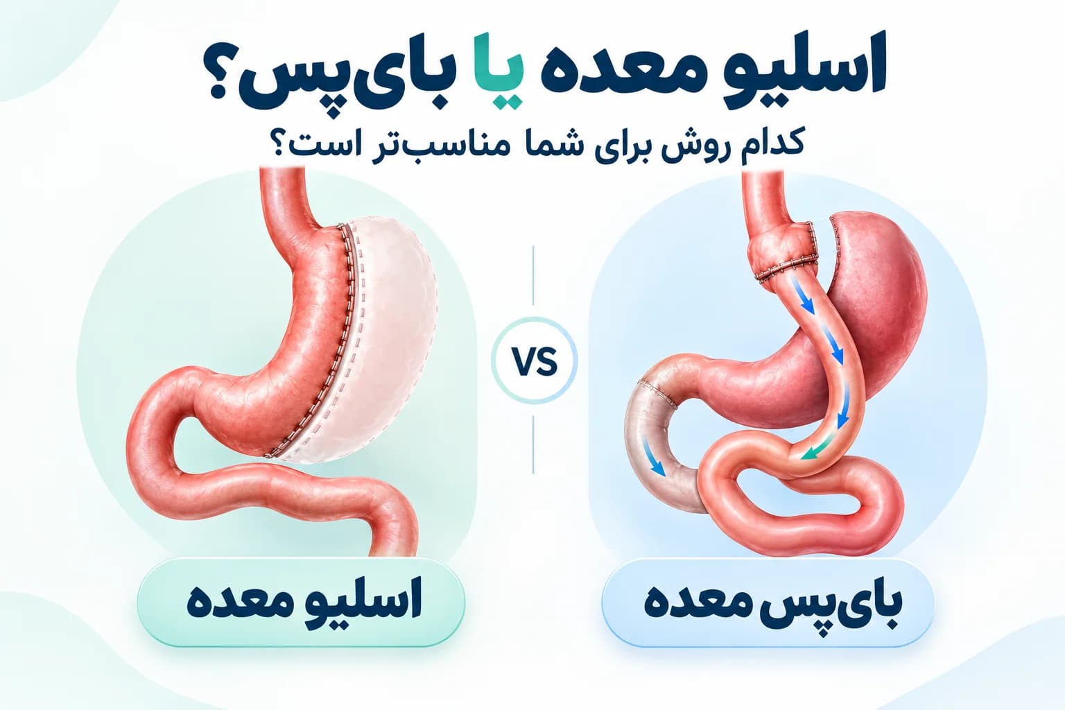 اسلیو معده یا بای پس